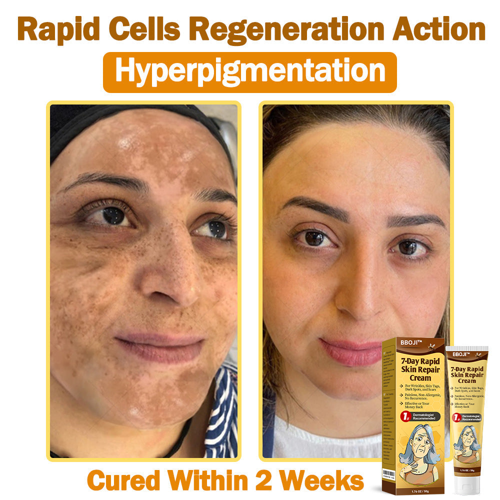BBOJI™ 𝟕-Tage Schnelle Hautreparaturcreme US-Dermatologen-zugelassen (🏆🔥AAD EMPFIEHLT)