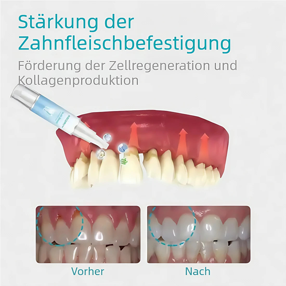 🔥Last Day Promotion 80% OFF-NESLEMY™ Gum Shield Therapy Gel