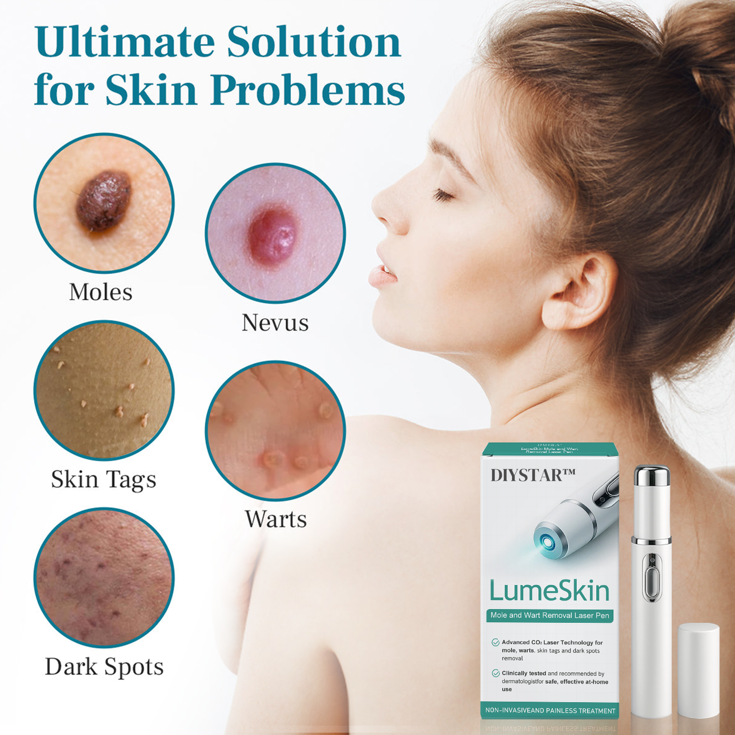 DIYSTAR™ LumeSkin Muttermal- und Warzenentfernungs-Laserstift 🟢1