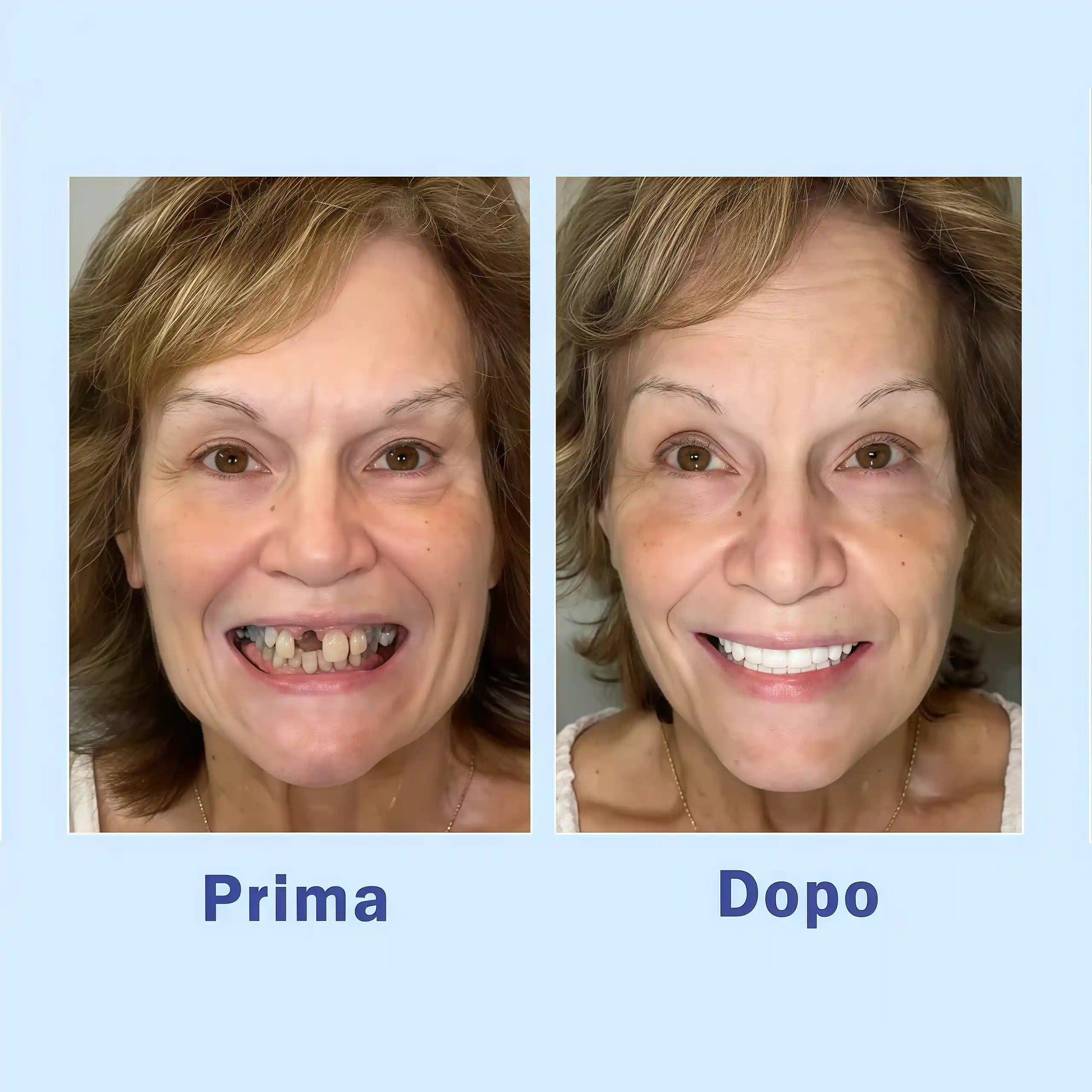 Venesh™ Protesi Dentaria di Alta Qualità 💎 – Acquista Ora Prima che Esaurita! ⏳🔥