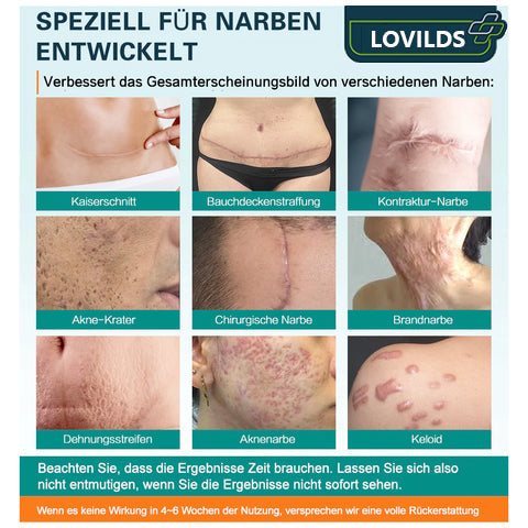 (🔥LETZTER TAG VERKAUF-70% RABATT) LOVILDS™ Fortgeschrittenes Narbenentfernungs-Spray