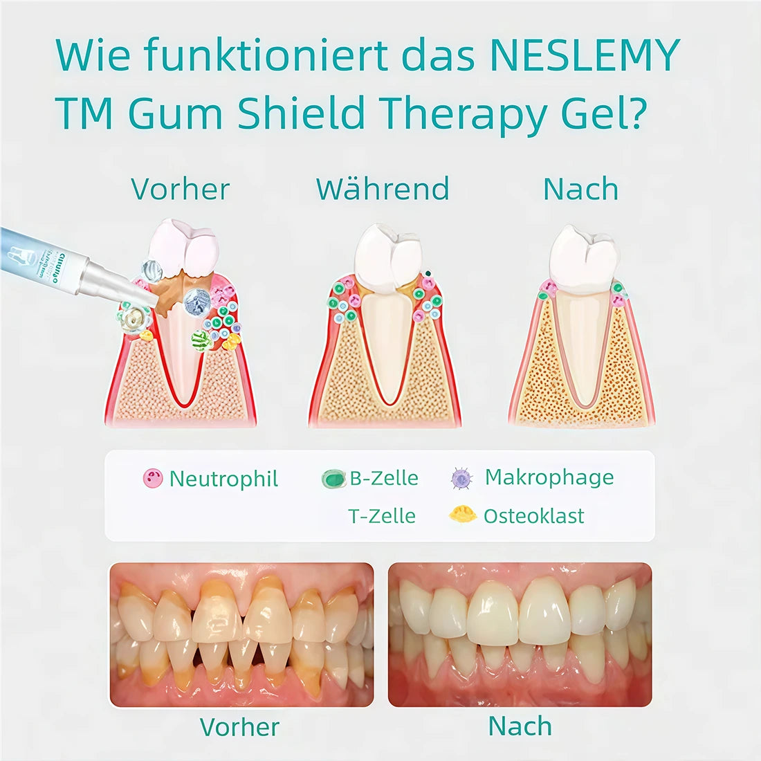 🔥Last Day Promotion 80% OFF-NESLEMY™ Gum Shield Therapy Gel