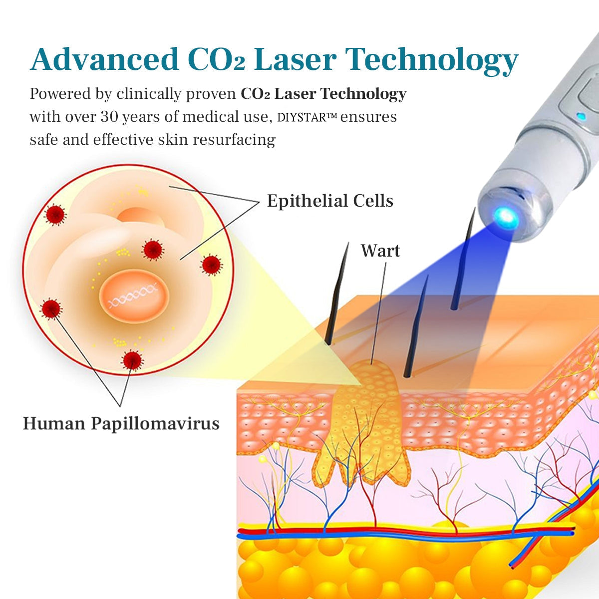 DIYSTAR™ LumeSkin Muttermal- und Warzenentfernungs-Laserstift 🟢1