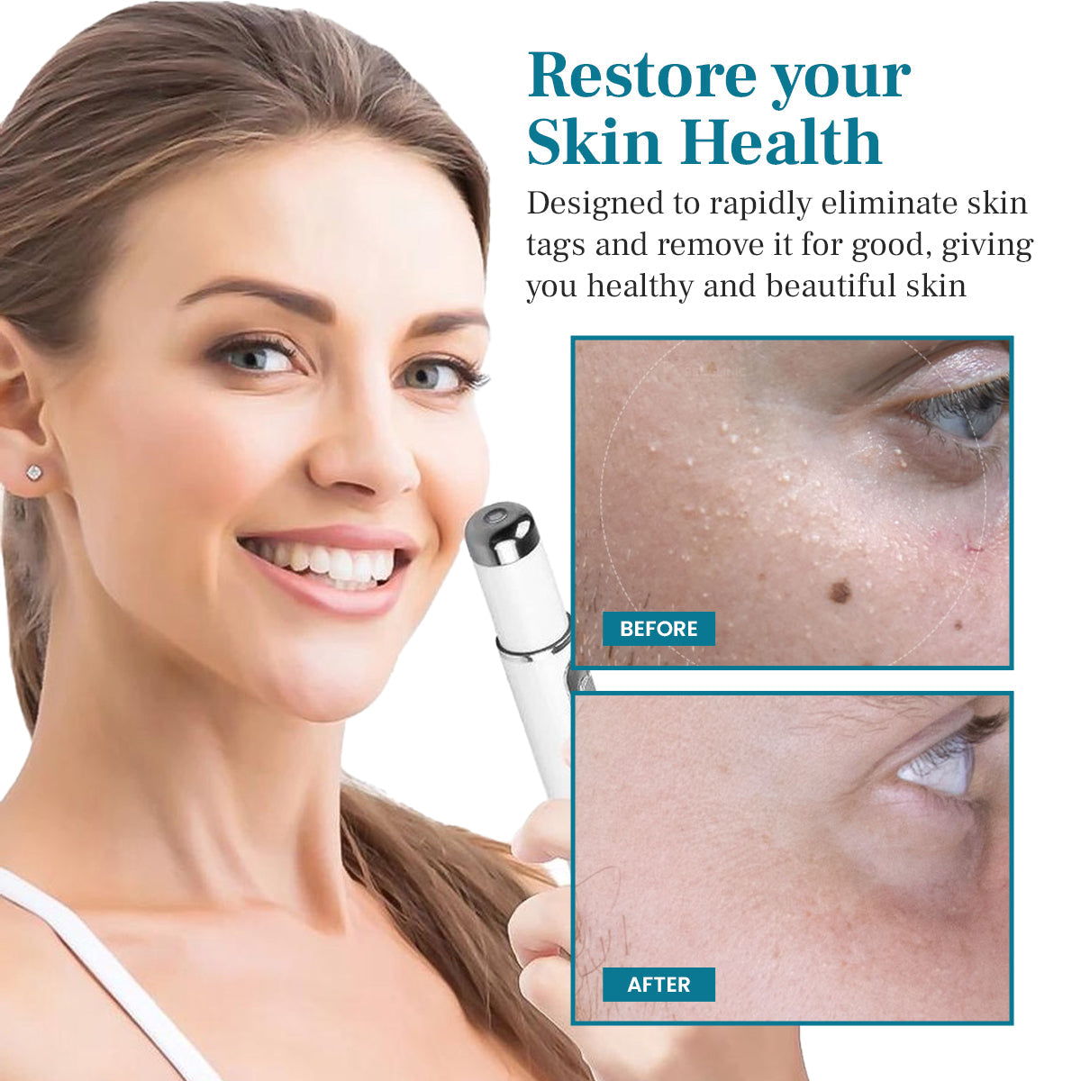 DIYSTAR™ LumeSkin Muttermal- und Warzenentfernungs-Laserstift 🟢1
